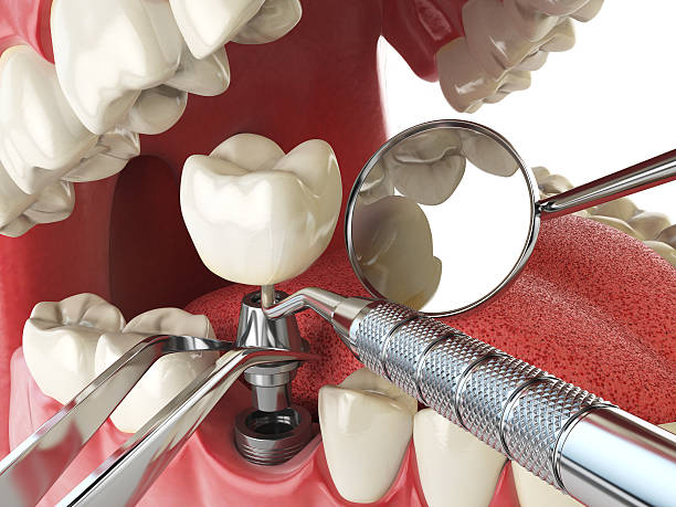 Best Knocked-Out Tooth (Avulsed Tooth) Treatment in Commerce, OK